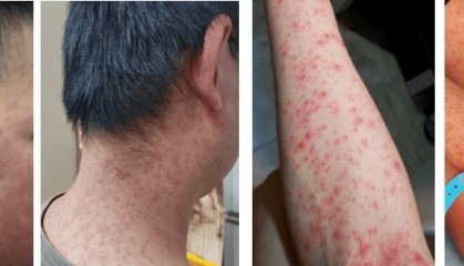 超6000例！仍在新增！或发展成慢性病及有后遗症！上海华山医院：这些驱蚊产品没用！